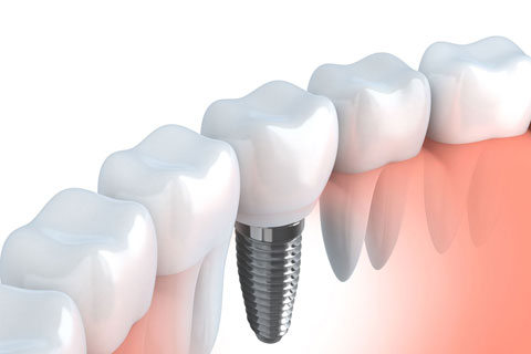 Restoring The Missing Tooth With Dental Implants