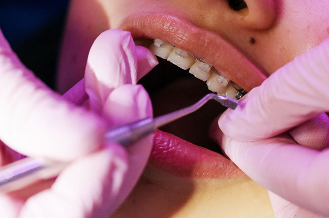 5 Tips to Take Care of Your Clear Braces