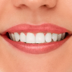 Best Professional Teeth Whitening Solutions | Sacramento