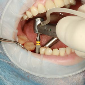 Can Dental Implants Be Done After Extraction? | Sacramento