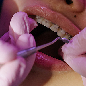 Steps To Keep Teeth White & Clean With Braces | Sacramento